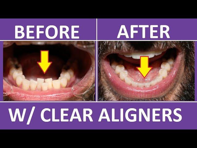 Invisalign Braces Before and After: Overbite, Crowding Teeth: Cost, Pain, Tips 3M Clear Aligners