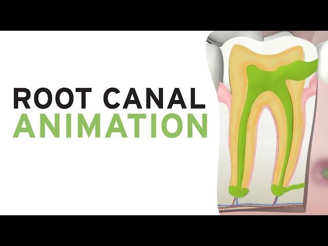 Root Canal Treatment RCT (Step by Step Animation)