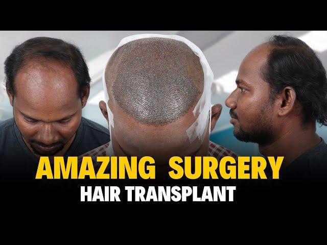 Hair Transplant In Surat | Best Results & Cost of Hair Transplant in Surat