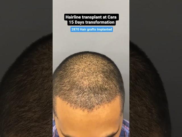 15 DAY TRANSFORMATION: See His Hair Before and After Sapphire FUE Hair Transplant