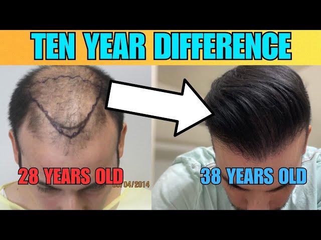 My Hair Transplant Journey 10 Years Later