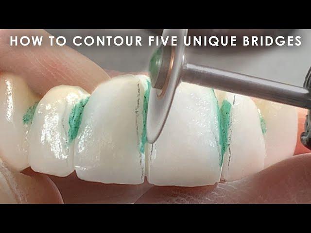 How to Contour Five Unique Bridges