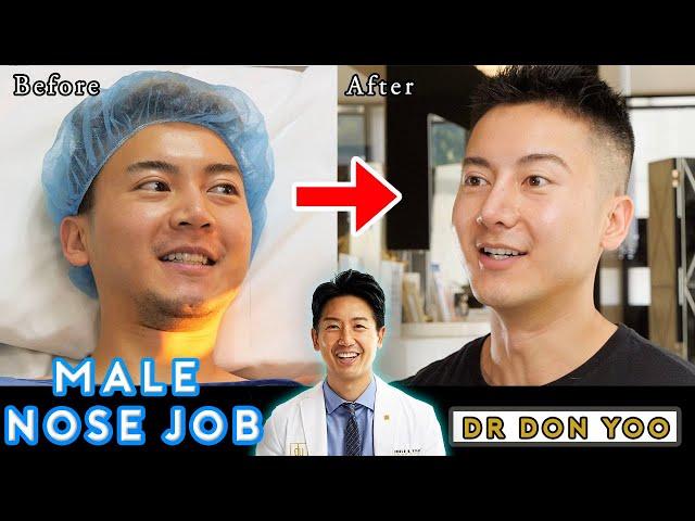 Male Nose Job Experience | Male Asian Rhinoplasty Surgery