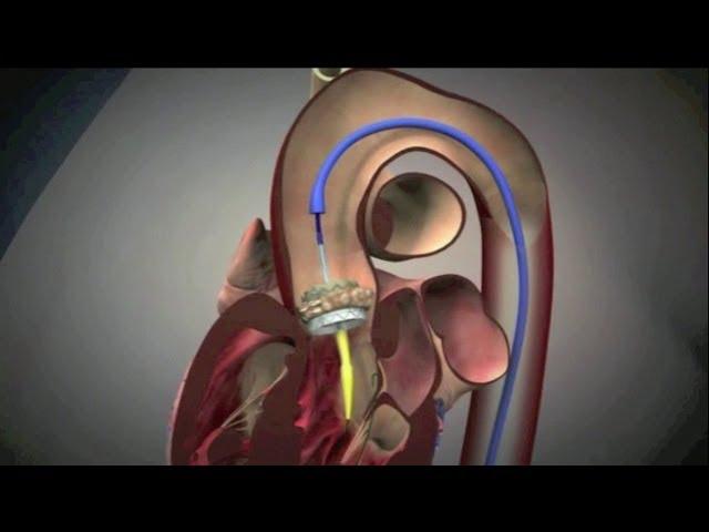 Transcatheter Aortic Valve Implantation (TAVI)