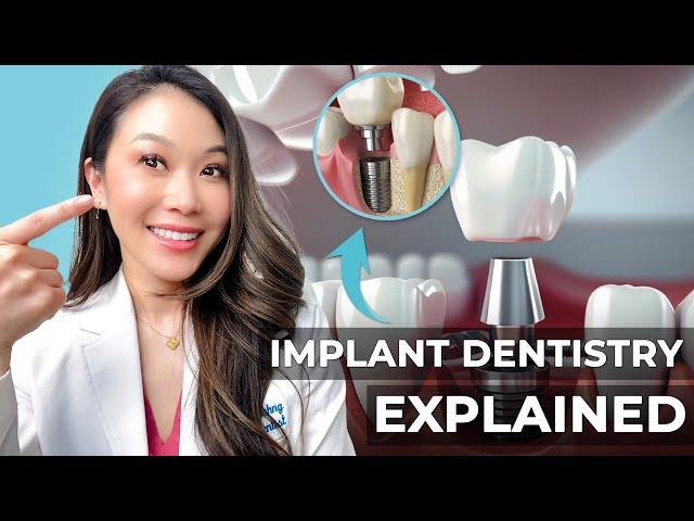 What’s a Dental Implant?