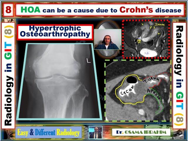 Hypertrophic OsteoArthropathy and Crohn's disease