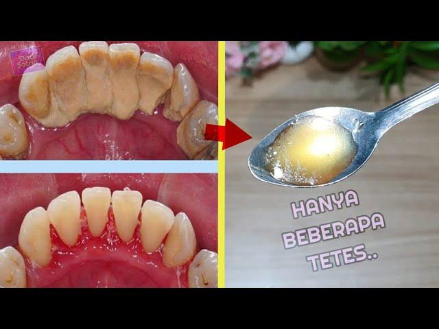 MUDAH KOK !! Cara Menghilangkan Karang Gigi Yang Menebal Tanpa Merusak Gigi || Dodi Satria