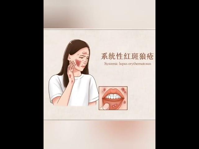 Know more Lupus erythematosus 了解更多红斑狼疮(國語版本)