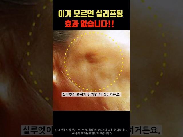실리프팅 실루엣소프트 강력추천하는 이유!! #실리프팅 #실루엣소프트 #리프팅 #lifting #modsclinic #모즈클리닉 #shorts