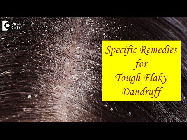 FLAKY SCALP DANDRUFF not cleared by Home Remedies. What to do? - Dr. Amee Daxini | Doctors' Circle
