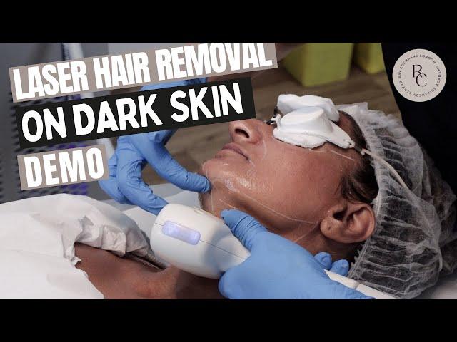 Laser Hair Removal On Darker Skin (Fitzpatrick Skin type 5) - Demonstration/Tutorial | What To Know