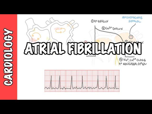 Atrial Fibrillation Overview - ECG, types, pathophysiology, treatment, complications