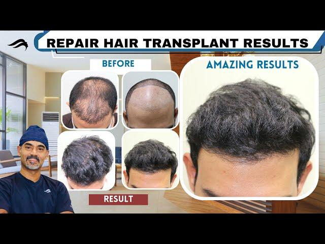 Hair Transplant In Chennai | Best Center Surgeon Cost & Results Of Hair Transplant Of Chennai