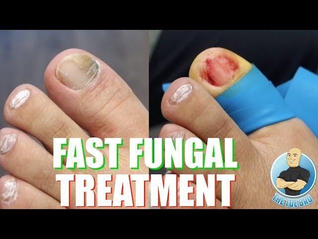 THE FASTEST WAY TO TREAT TOENAIL FUNGUS?!