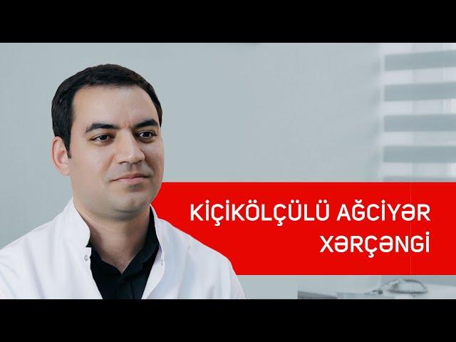 Kiçikölçülü ağciyər xərçəngi  - Torakal cərrah Uzm.Dr. Nurlan Əlizadə