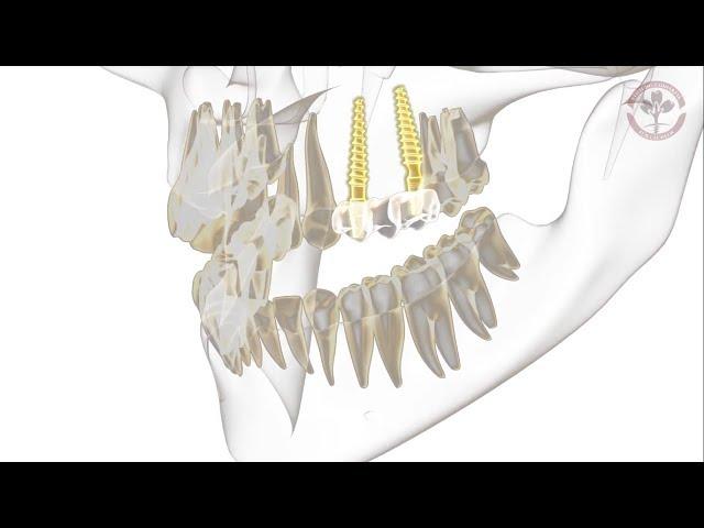 Ablauf einer Sofortimplantation - Implantatbrücke [Erklärvideo]