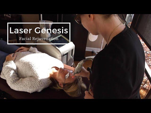 Laser Genesis | Facial Rejuvenation Treatment