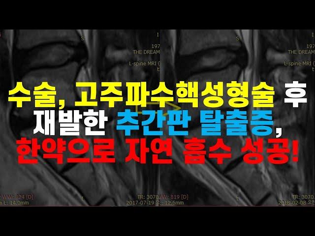 수술도 받고 고주파 수핵 성형술도 받았지만 재발한 추간판 탈출증, 한약으로 자연 흡수 성공!
