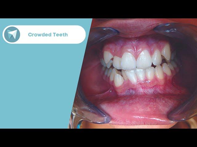 Crowded Teeth Treatment Before / After - Forest & Ray - Dentists, Orthodontists, Implant Surgeons