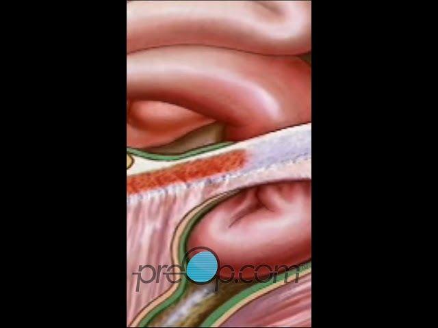 Hernia Repair Inguinal (Open) Surgery PreOp® Patient Education & Patient Engagement #shorts