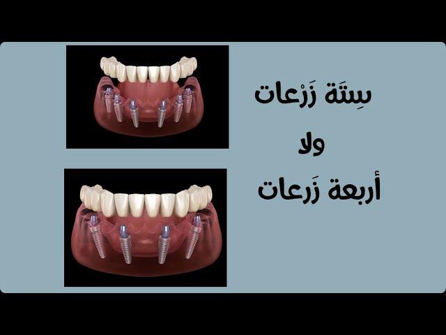 ازاي احدد عدد الزرعات المطلوبة لكل فك؟ ٤ ولا ٦ ولا حتي ٨ زرعات؟