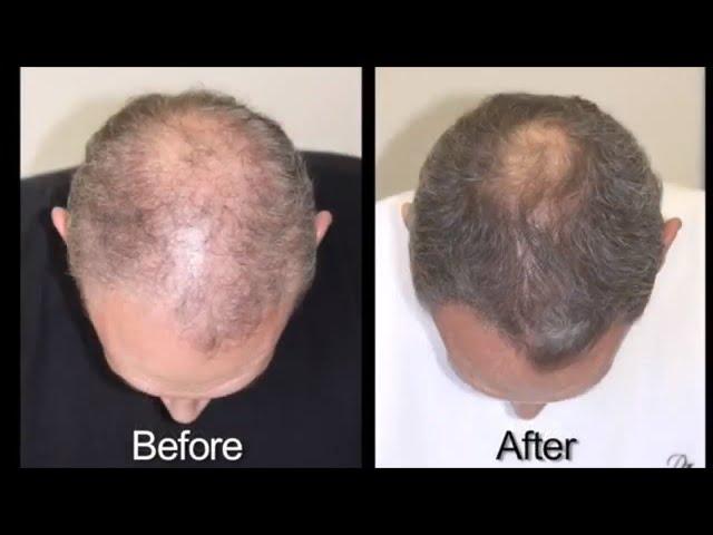 Hair Loss Treatment for Men with Advanced Trichology