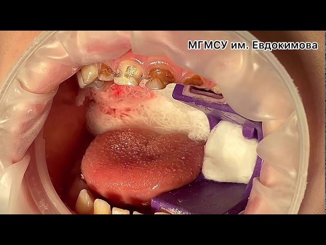 Практическое занятия: Экстирпационный метод лечения пульпита временного однокорневого зуба