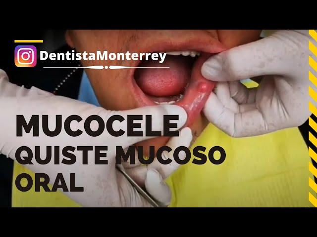 MUCOCELE - QUISTE MUCOSO BUCAL  DentalTip