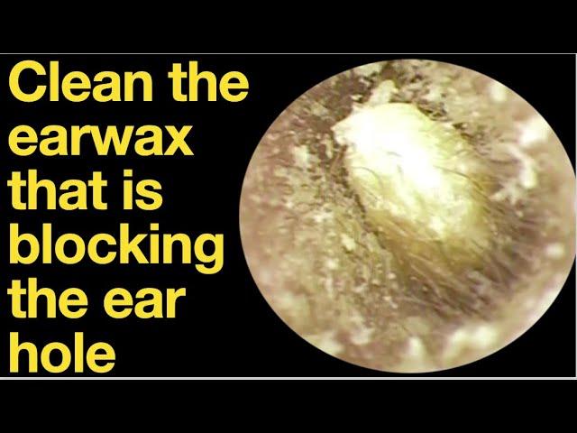 Clean the earwax that is blocking the ear hole|ear wax removal | ear cleaning | ASMR | relaxation