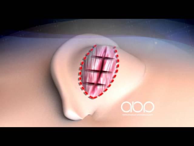 Otoplasty - 3D Medical Animation || ABP ©