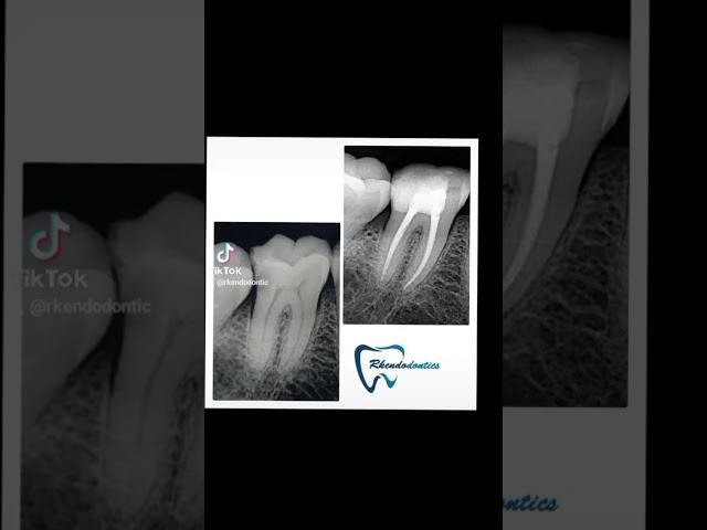 #rootcanalspecialist #dentistrylove #dentist #dentistry #dental #dentalworld