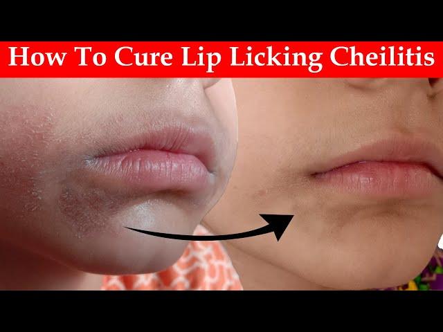 How To Cure Lip Licking Cheilitis?