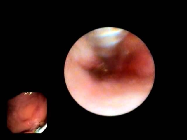 Cholangiocarcinoma with obstruction of right hepatic duct case study, D. Adler MD