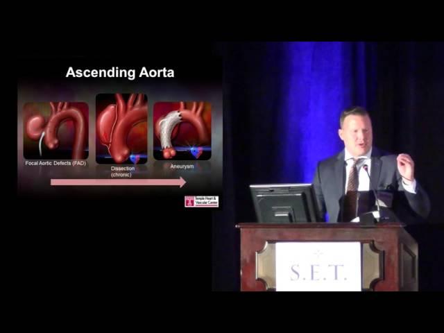 Update of TEVAR for the Ascending Aorta and Aortic Root