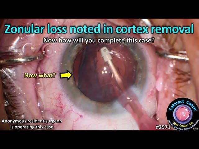 CataractCoach™ 2571: zonular loss noted in cortex removal
