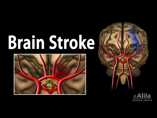 Brain Stroke, Types of, Causes, Pathology, Symptoms, Treatment and Prevention, Animation.