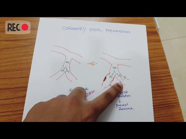 MECHANISM OF CORONARY STEAL PHENOMENON /SYNDROME  # EASY WAY