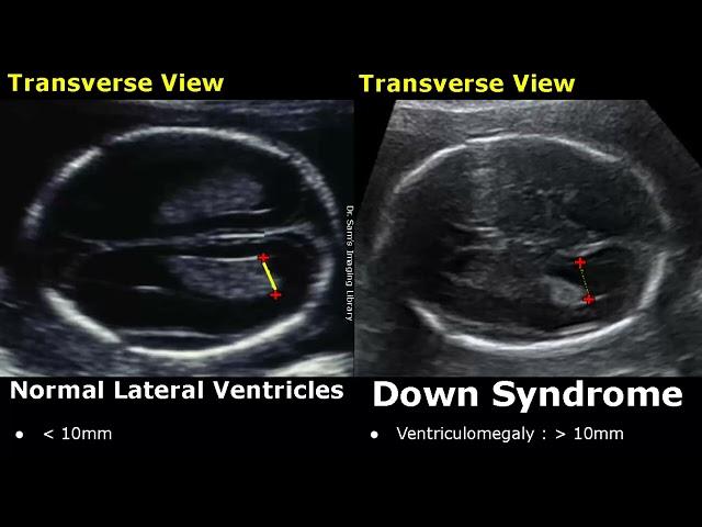 Fetal Ultrasound Normal Vs Down Syndrome | Soft Markers In Fetus For Trisomy 21 | Aneuploidies USG