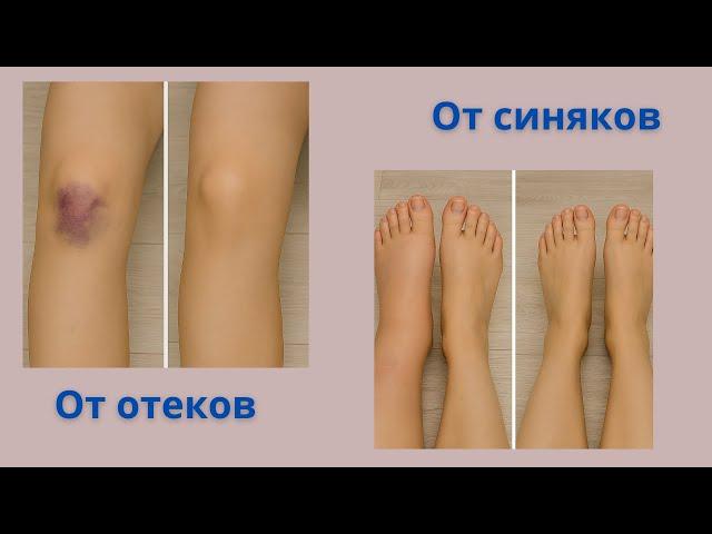 How to quickly remove a bruise at home in a simple way!