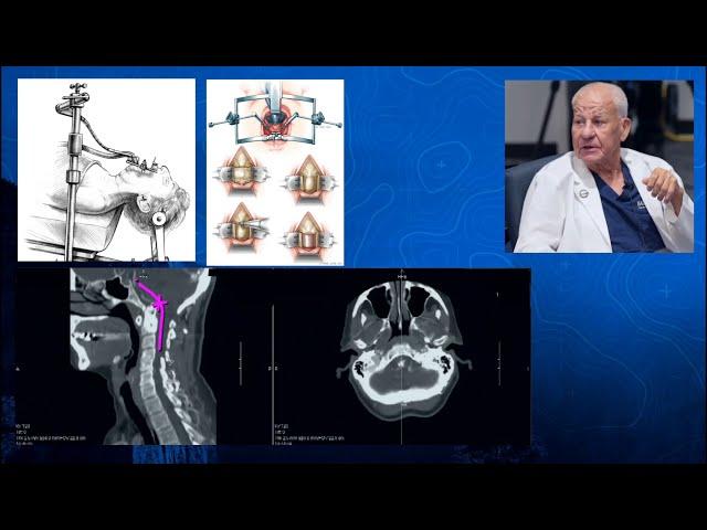 Episode 13 Part 1: Giants of Spine Surgery - Craniocervical Junction Surgery - Volker Sonntag, MD