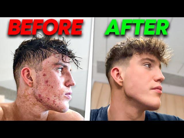 How I Cleared My Acne