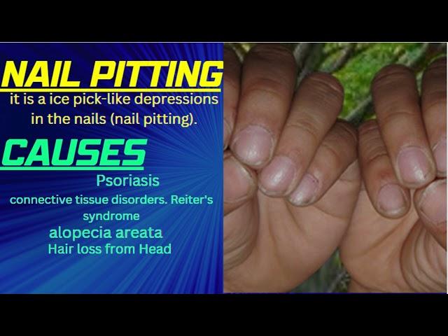 Nail Pitting | Nail Pitting causes | Nail Pitting Treatment