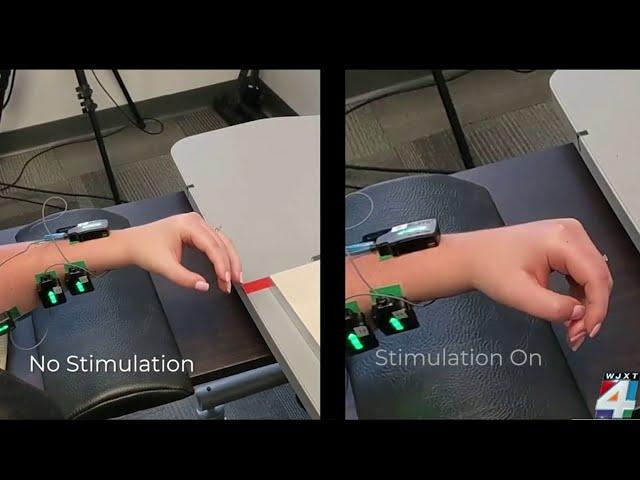 Neurotechnology instantly helps stroke patients move