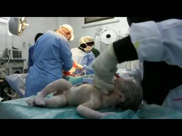 A miracle child - DOCTORS SAVE LIFELESS BABY