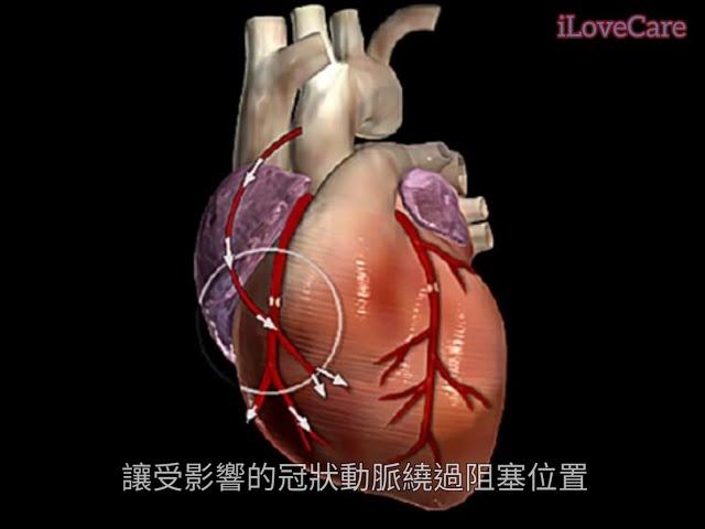 【1分鐘理解心臟搭橋手術】《 Understand  Coronary Artery Bypass Grafting (CABG)  in 1 min 》