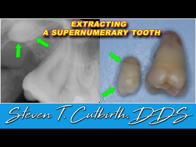 Extracting a Supernumerary Tooth - Dental Minute with Steven T. Cutbirth, DDS