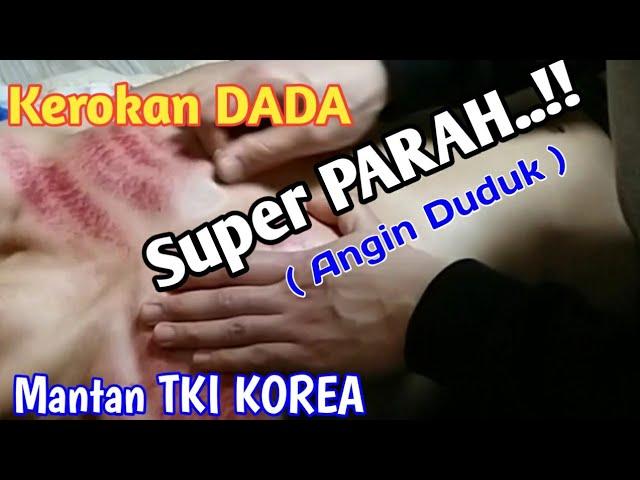 Kerokan DADA ( Masuk Angin ) Super Parah..!!  Mantan TKI KOREA