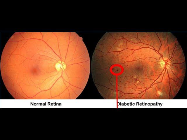 Detecting & Implementing Diabetic Retinopathy with AI |  +91-7973788405 for query| Webtunix AI