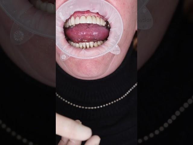 Dental implant’s in Prague #shorts #dentist #dental #implant #veneers #short