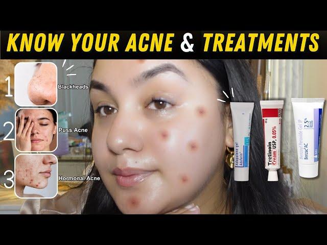 Pharmacy Creams to Treat Your Acne Right !